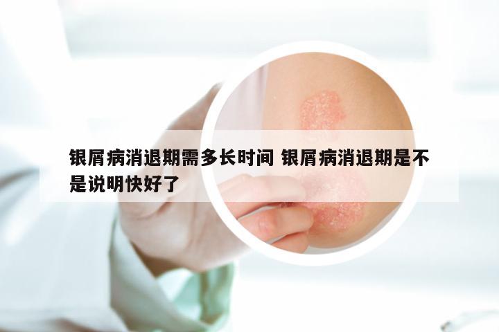 银屑病消退期需多长时间 银屑病消退期是不是说明快好了