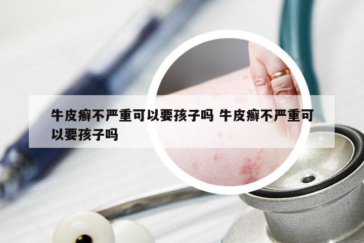 牛皮癣不严重可以要孩子吗 牛皮癣不严重可以要孩子吗
