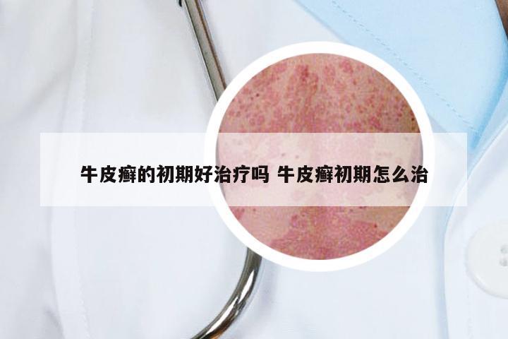 牛皮癣的初期好治疗吗 牛皮癣初期怎么治