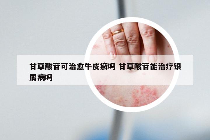 甘草酸苷可治愈牛皮癣吗 甘草酸苷能治疗银屑病吗