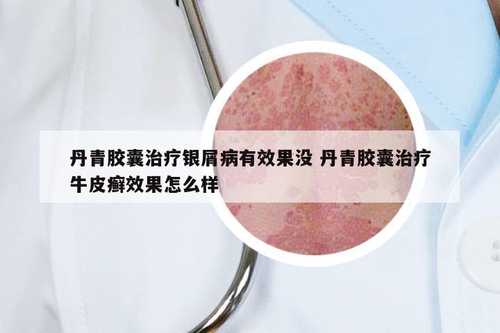 丹青胶囊治疗银屑病有效果没 丹青胶囊治疗牛皮癣效果怎么样
