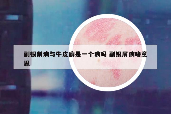 副银削病与牛皮癣是一个病吗 副银屑病啥意思