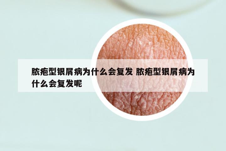 脓疱型银屑病为什么会复发 脓疱型银屑病为什么会复发呢