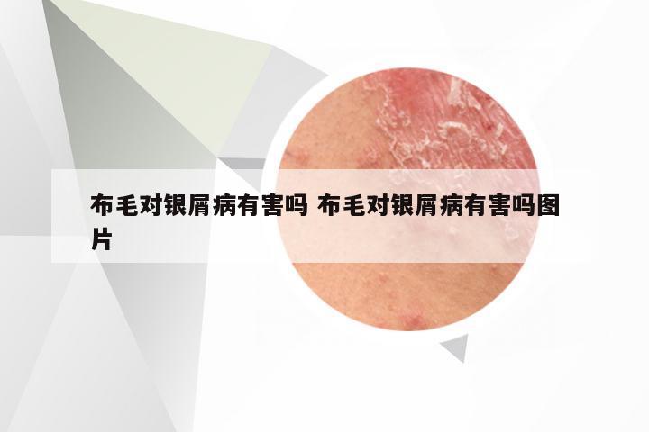 布毛对银屑病有害吗 布毛对银屑病有害吗图片