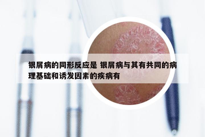 银屑病的同形反应是 银屑病与其有共同的病理基础和诱发因素的疾病有