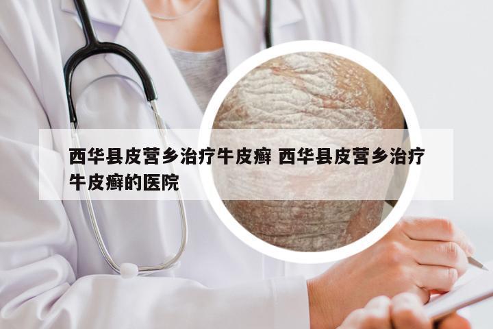 西华县皮营乡治疗牛皮癣 西华县皮营乡治疗牛皮癣的医院