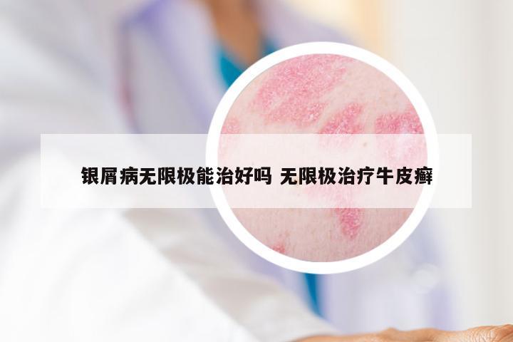 银屑病无限极能治好吗 无限极治疗牛皮癣