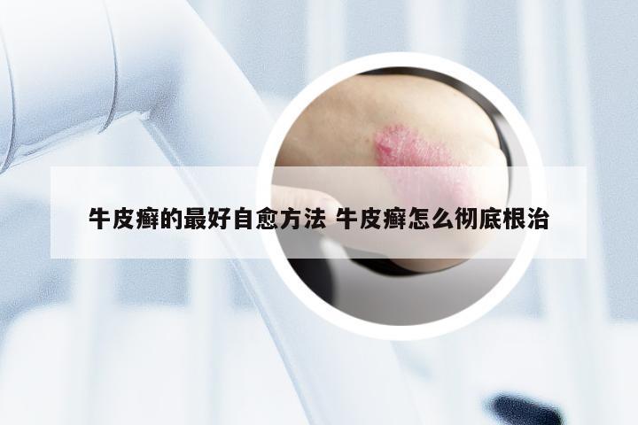 牛皮癣的最好自愈方法 牛皮癣怎么彻底根治