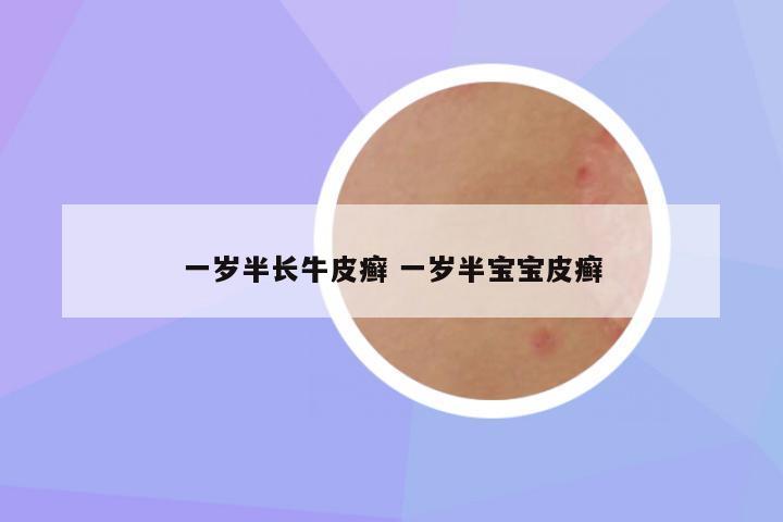 一岁半长牛皮癣 一岁半宝宝皮癣