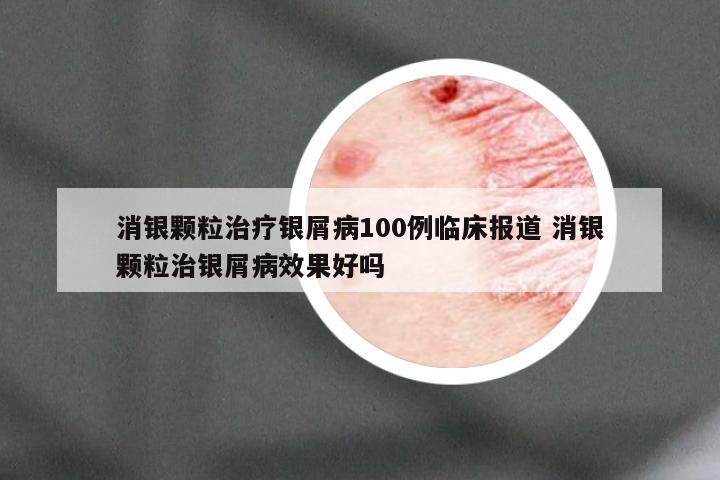 消银颗粒治疗银屑病100例临床报道 消银颗粒治银屑病效果好吗