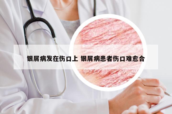 银屑病发在伤口上 银屑病患者伤口难愈合