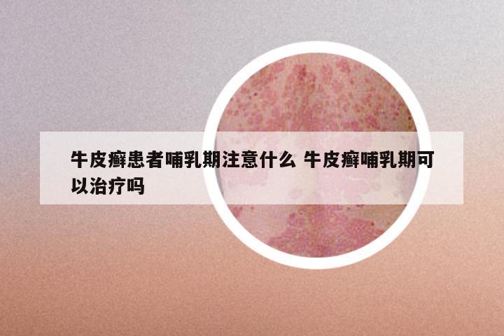 牛皮癣患者哺乳期注意什么 牛皮癣哺乳期可以治疗吗