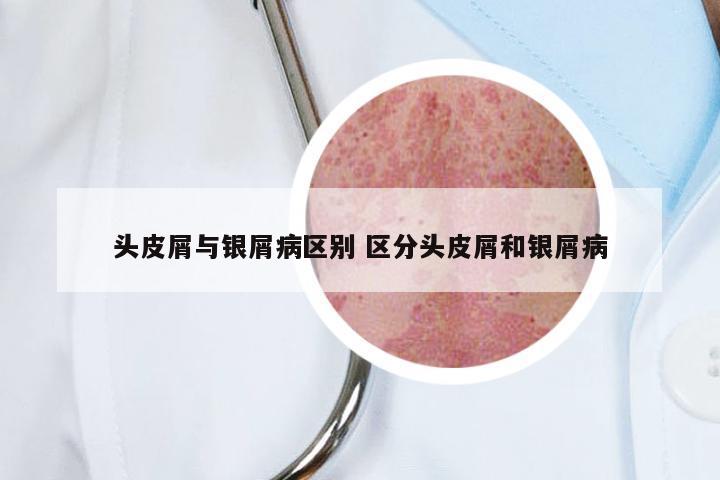 头皮屑与银屑病区别 区分头皮屑和银屑病