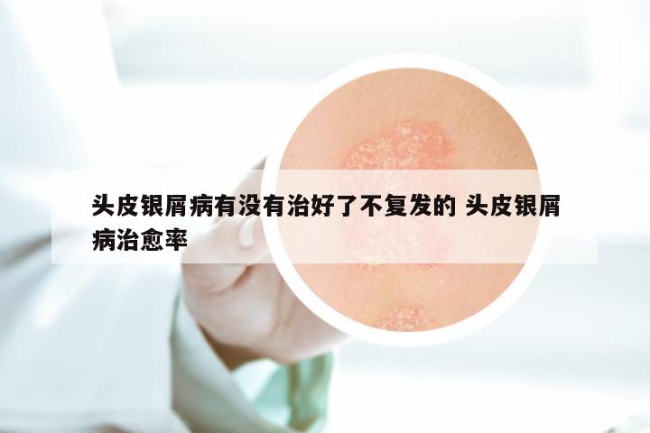 头皮银屑病有没有治好了不复发的 头皮银屑病治愈率