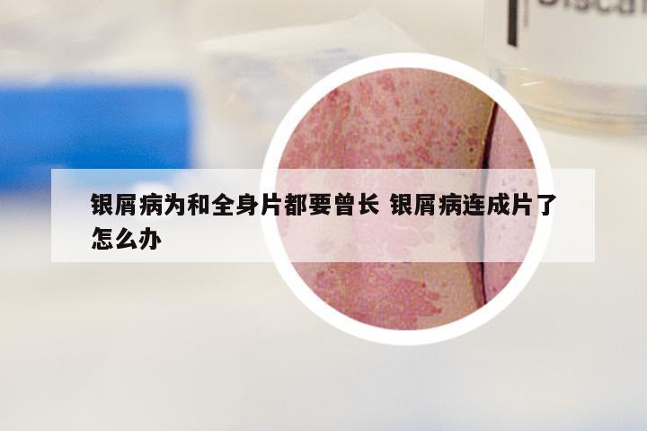 银屑病为和全身片都要曾长 银屑病连成片了怎么办