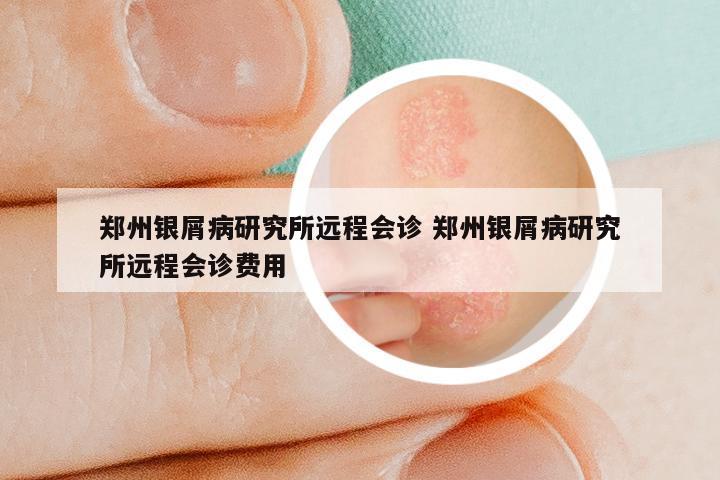 郑州银屑病研究所远程会诊 郑州银屑病研究所远程会诊费用