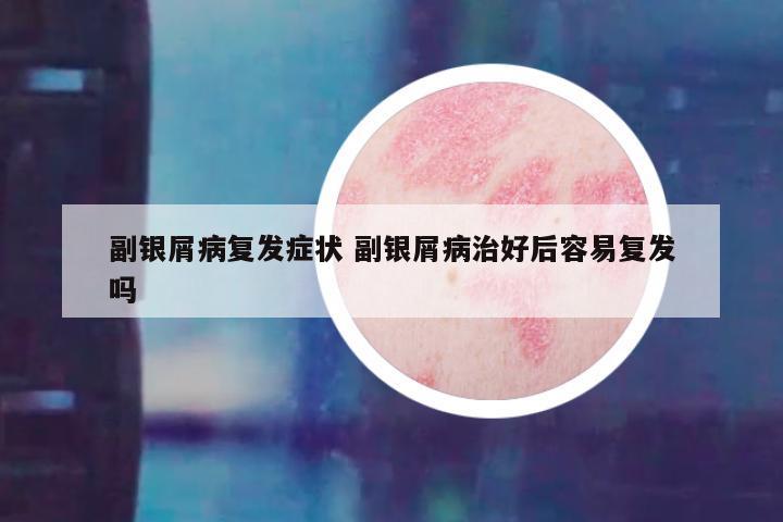 副银屑病复发症状 副银屑病治好后容易复发吗