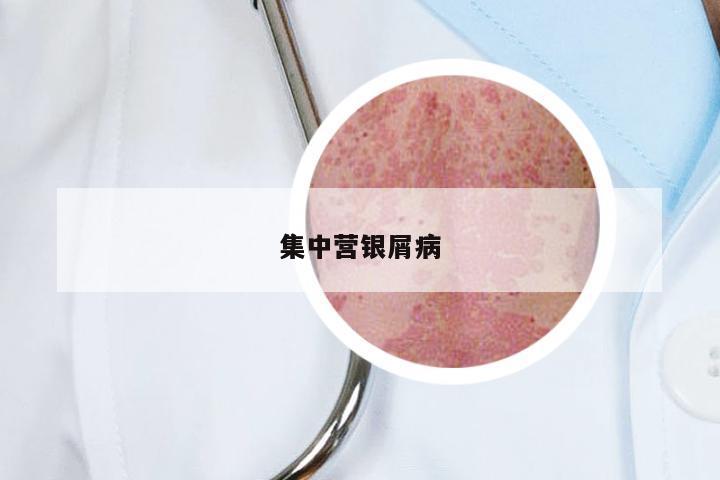 集中营银屑病