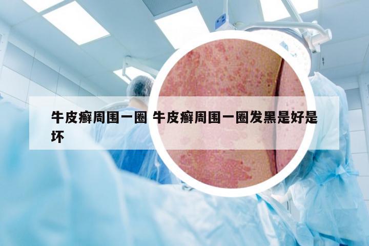 牛皮癣周围一圈 牛皮癣周围一圈发黑是好是坏