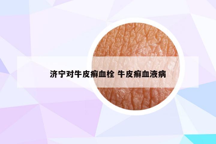 济宁对牛皮癣血栓 牛皮癣血液病