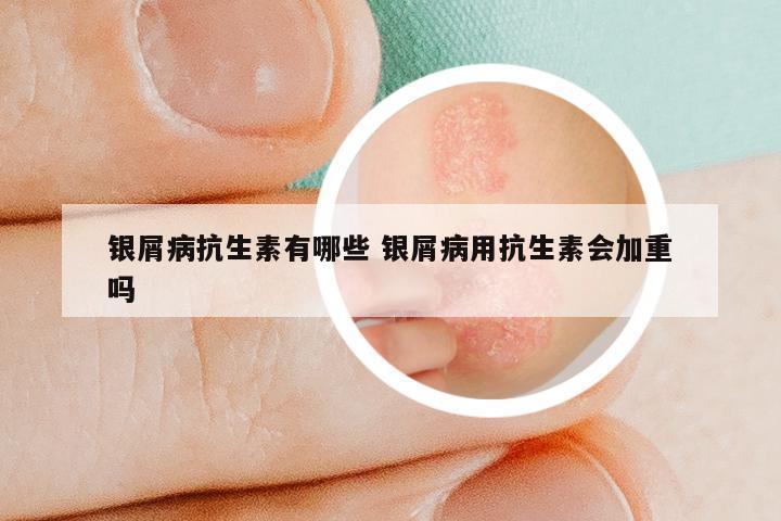 银屑病抗生素有哪些 银屑病用抗生素会加重吗