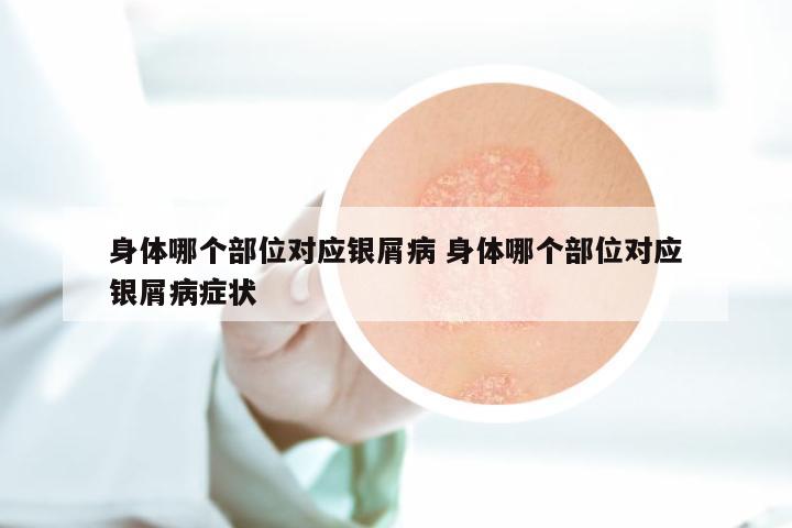 身体哪个部位对应银屑病 身体哪个部位对应银屑病症状