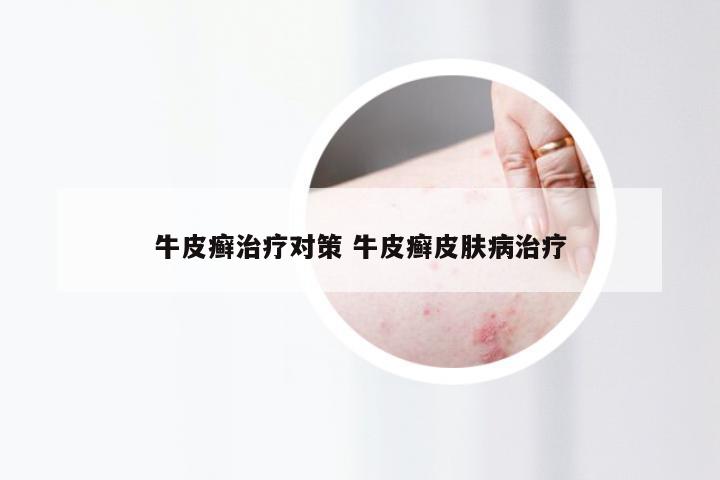 牛皮癣治疗对策 牛皮癣皮肤病治疗