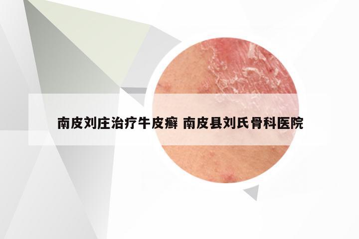 南皮刘庄治疗牛皮癣 南皮县刘氏骨科医院
