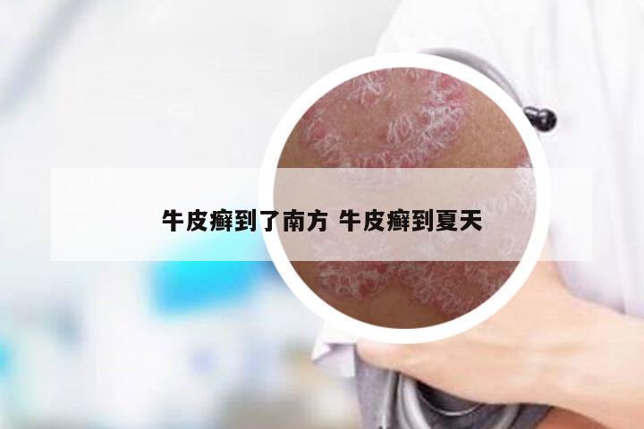 牛皮癣到了南方 牛皮癣到夏天