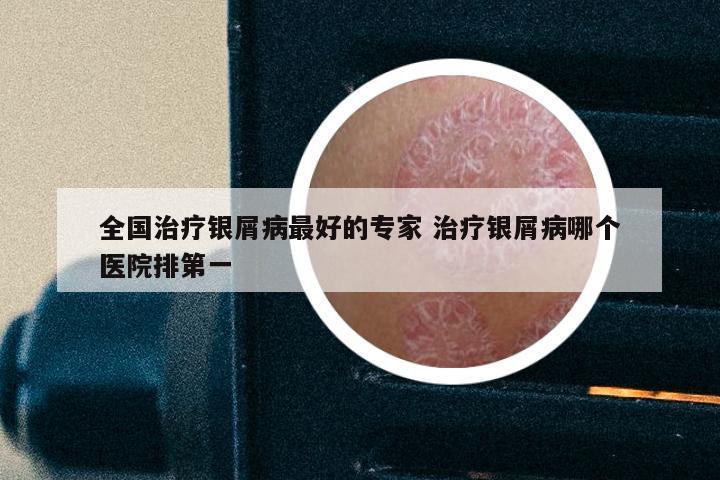 全国治疗银屑病最好的专家 治疗银屑病哪个医院排第一