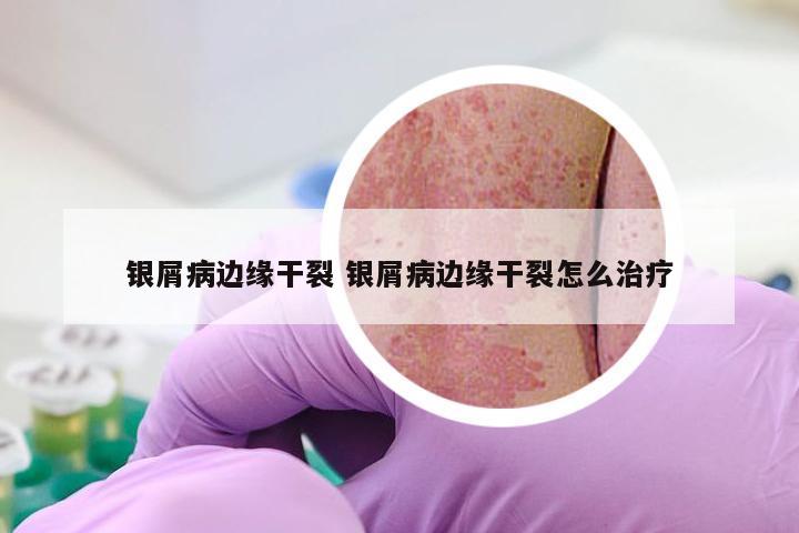 银屑病边缘干裂 银屑病边缘干裂怎么治疗