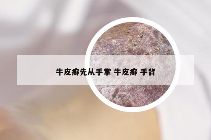 牛皮癣先从手掌 牛皮癣 手背