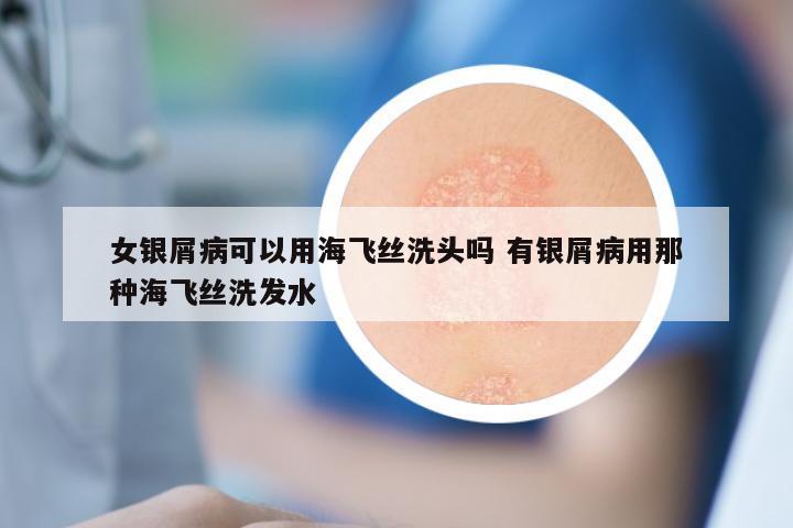女银屑病可以用海飞丝洗头吗 有银屑病用那种海飞丝洗发水