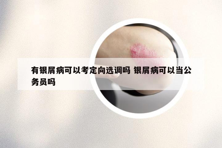 有银屑病可以考定向选调吗 银屑病可以当公务员吗