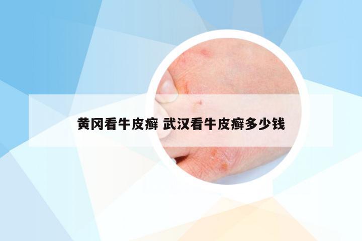黄冈看牛皮癣 武汉看牛皮癣多少钱