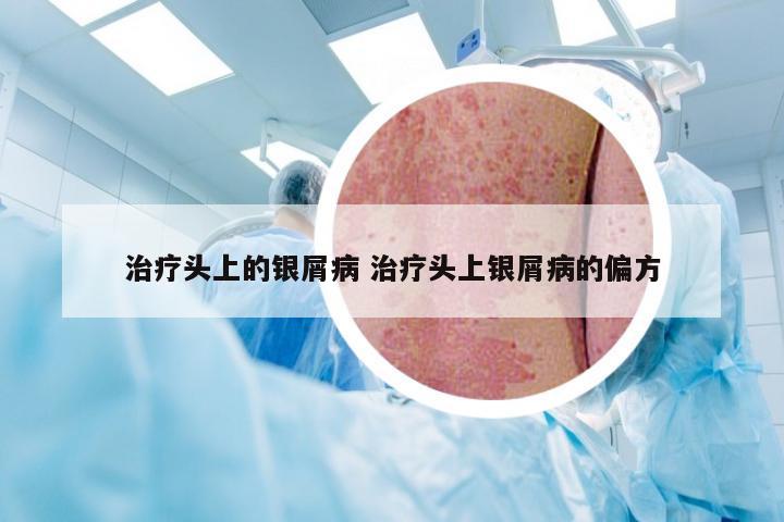 治疗头上的银屑病 治疗头上银屑病的偏方