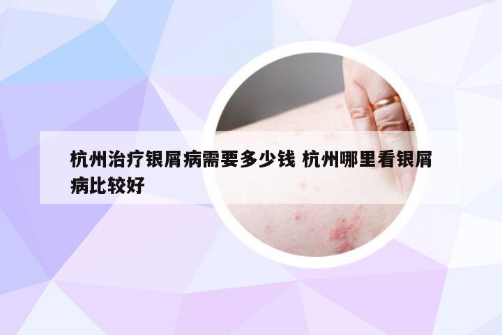 杭州治疗银屑病需要多少钱 杭州哪里看银屑病比较好
