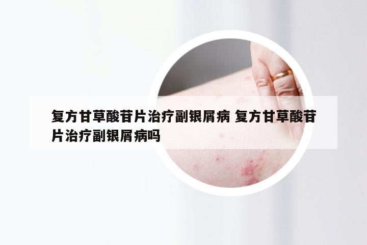 复方甘草酸苷片治疗副银屑病 复方甘草酸苷片治疗副银屑病吗