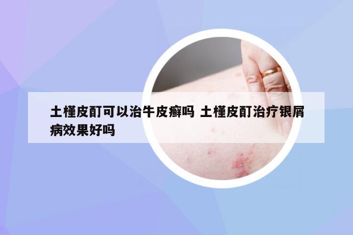 土槿皮酊可以治牛皮癣吗 土槿皮酊治疗银屑病效果好吗