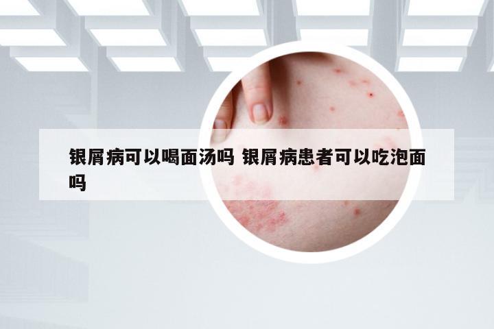 银屑病可以喝面汤吗 银屑病患者可以吃泡面吗