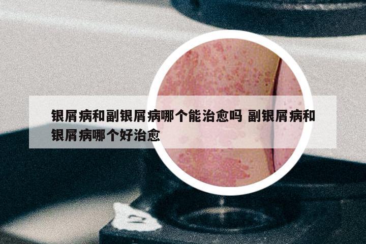 银屑病和副银屑病哪个能治愈吗 副银屑病和银屑病哪个好治愈