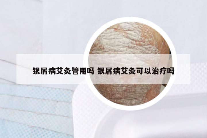 银屑病艾灸管用吗 银屑病艾灸可以治疗吗