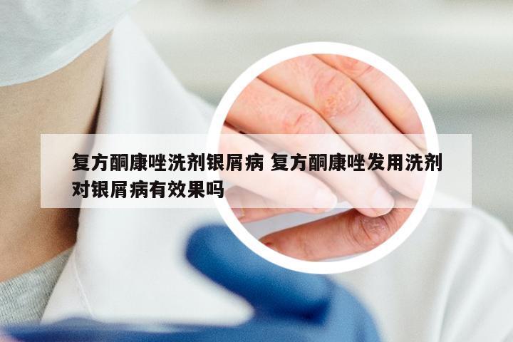 复方酮康唑洗剂银屑病 复方酮康唑发用洗剂对银屑病有效果吗