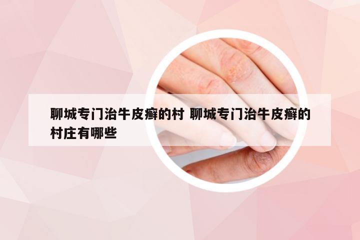 聊城专门治牛皮癣的村 聊城专门治牛皮癣的村庄有哪些