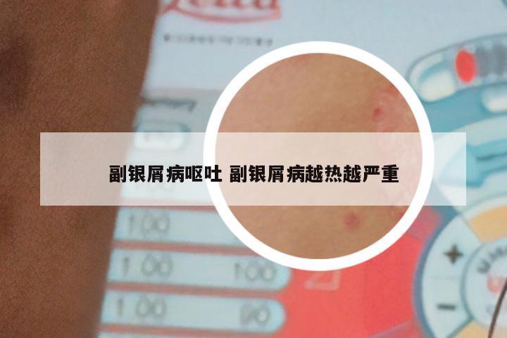 副银屑病呕吐 副银屑病越热越严重
