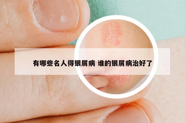 有哪些名人得银屑病 谁的银屑病治好了