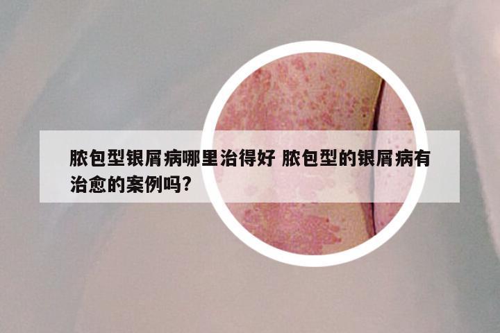 脓包型银屑病哪里治得好 脓包型的银屑病有治愈的案例吗?