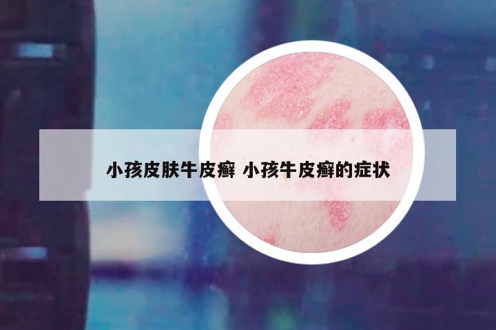 小孩皮肤牛皮癣 小孩牛皮癣的症状