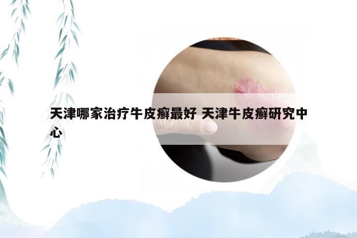 天津哪家治疗牛皮癣最好 天津牛皮癣研究中心