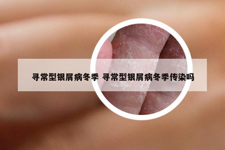 寻常型银屑病冬季 寻常型银屑病冬季传染吗